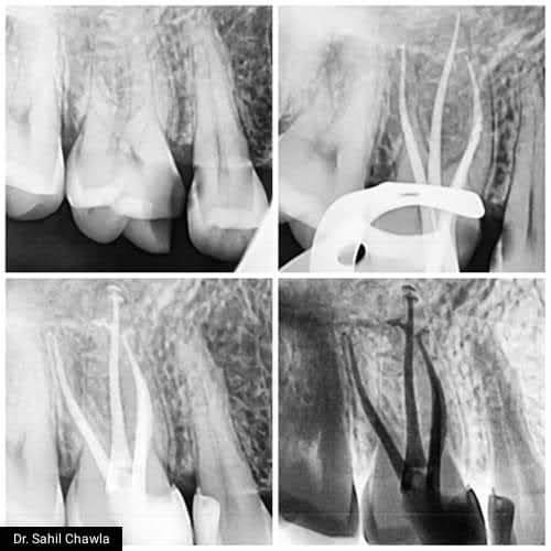Root canal retreatment case — radiographic sequence