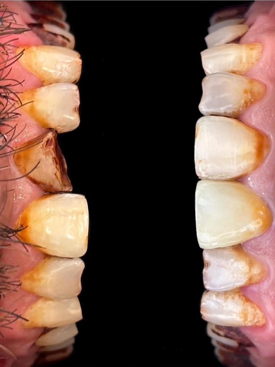 Mid-treatment full-mouth rehabilitation — untreated quadrant beside newly placed crowns