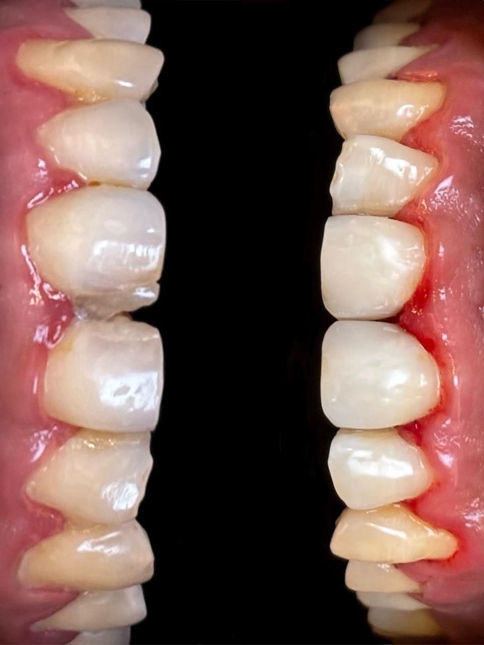 Completed full-arch crown and bridge restoration, lingual view