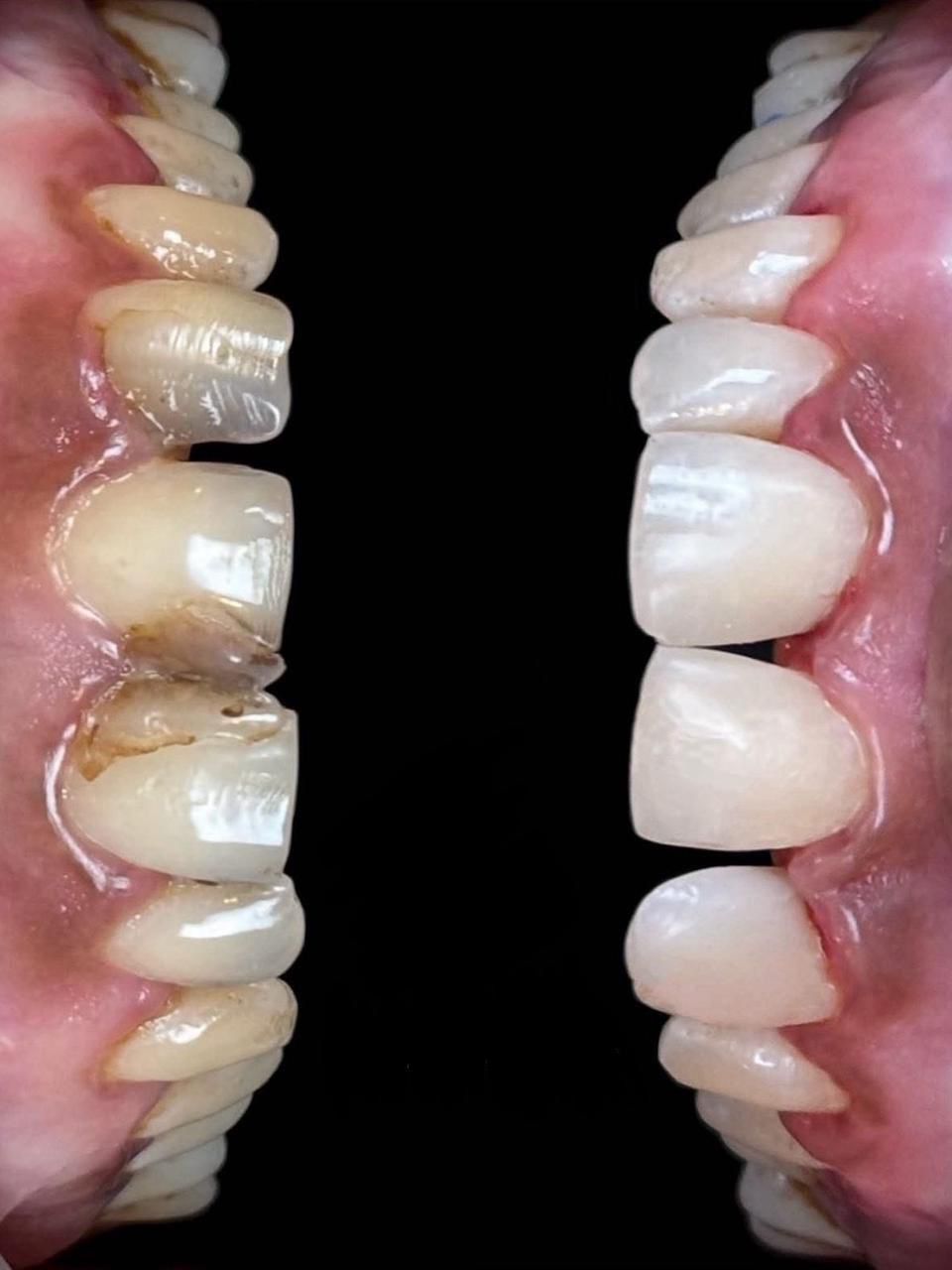 Worn, flattened natural teeth beside newly restored full-coverage crowns