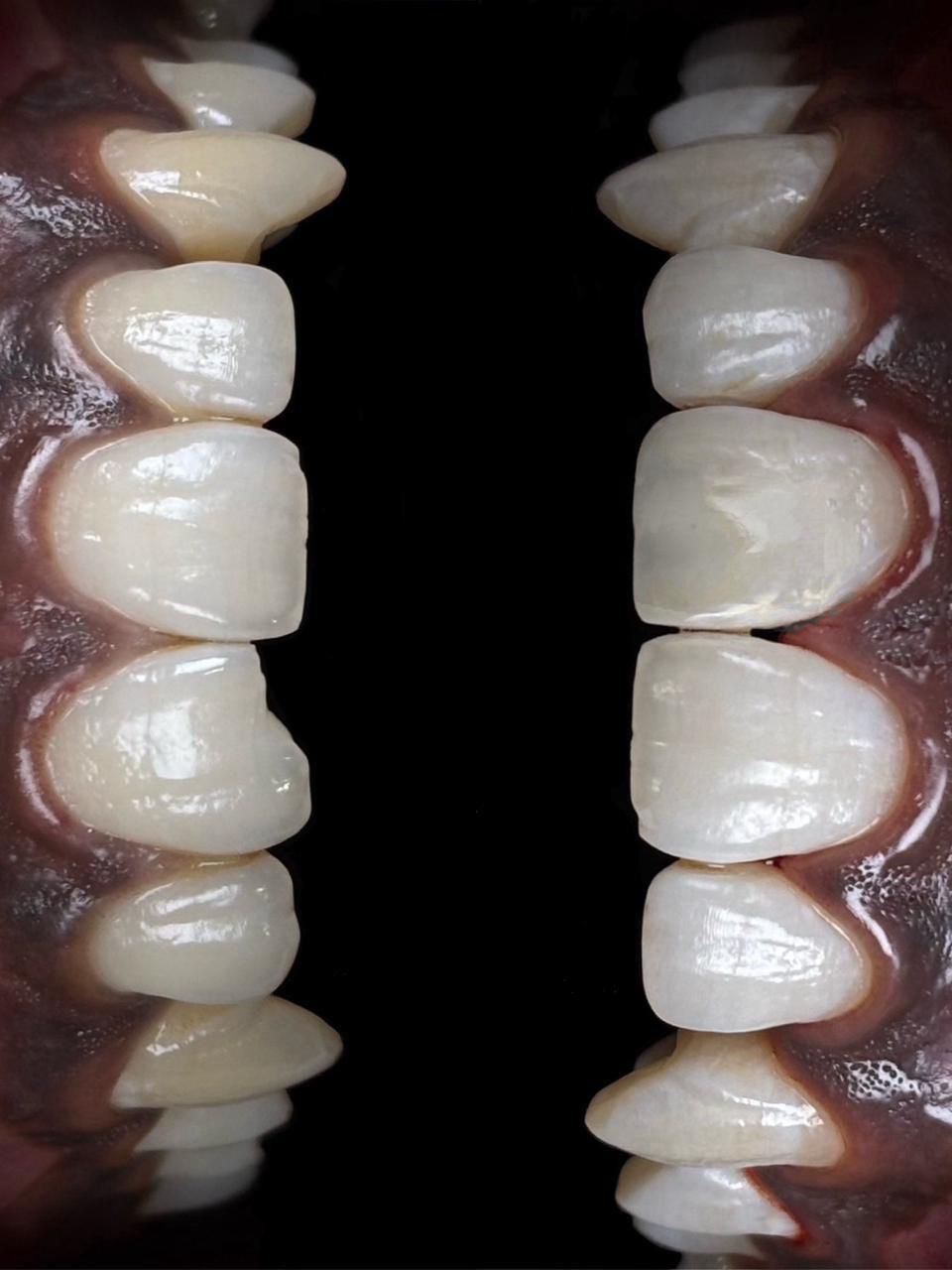 Final result of full-mouth crown restoration with healthy gum tissue