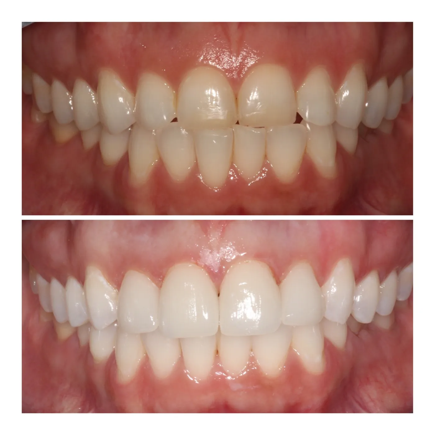 Full mouth smile makeover before and after in Raipur — discolored worn crowns replaced with a bright, even smile