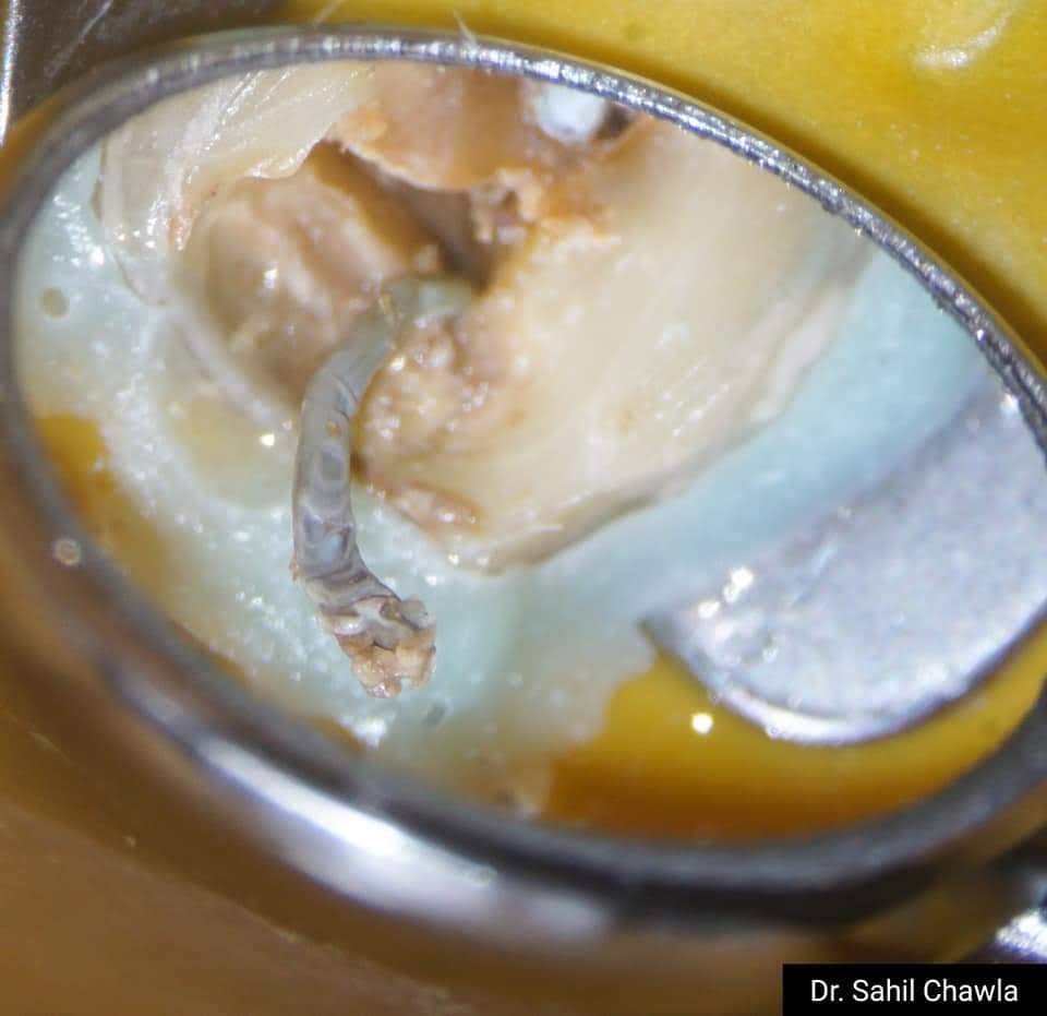 Canal identification under dental magnification