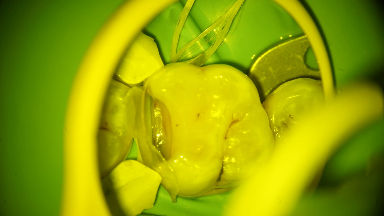 Access cavity preparation viewed under dental magnification with rubber dam isolation