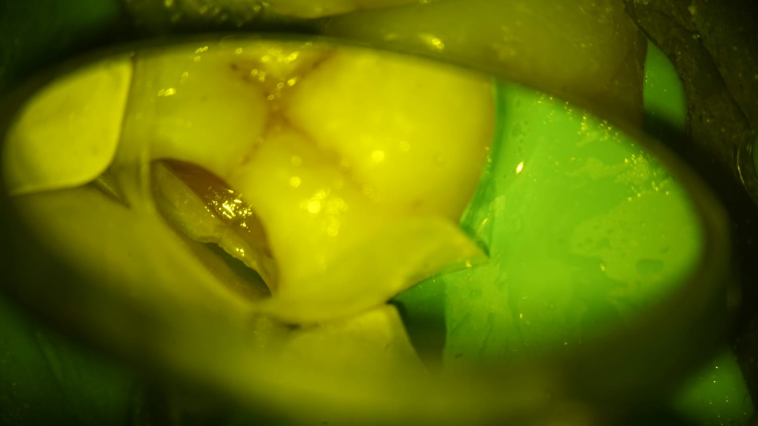 Occlusal view of molar tooth examined under dental magnification