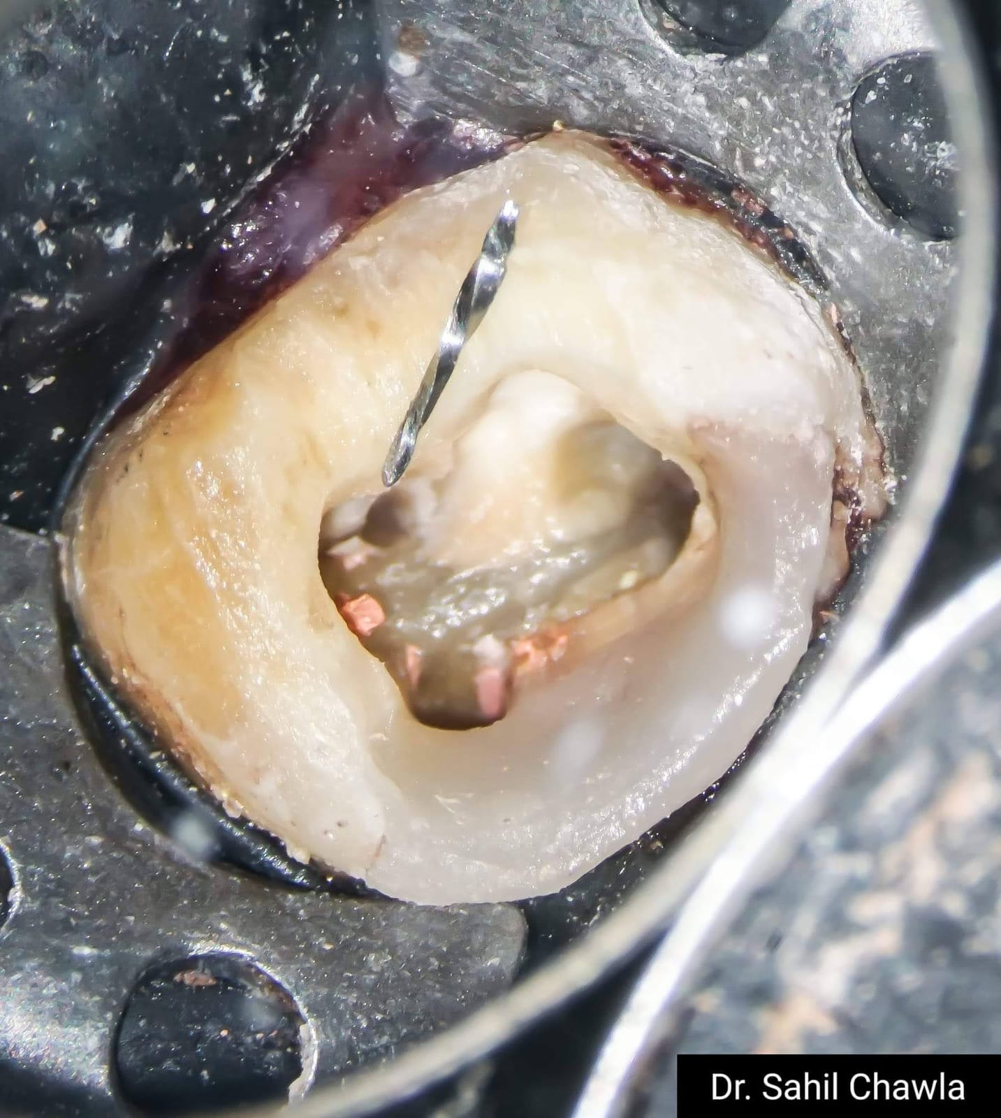 Canal location and instrumentation under dental magnification