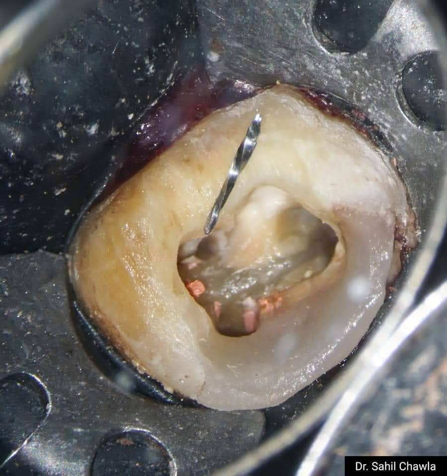 Close-up view of molar canal orifices during root canal treatment