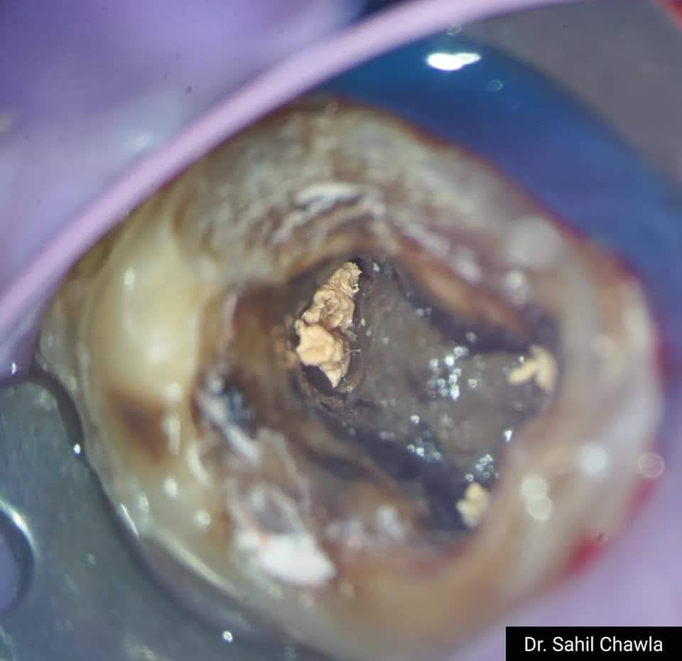 Deep carious lesion viewed under dental magnification before treatment